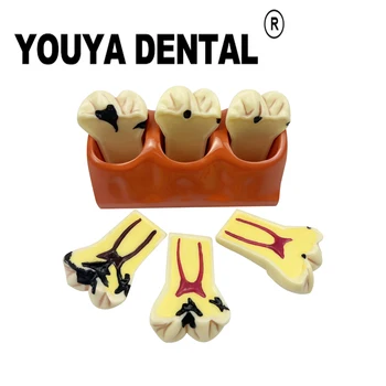 4 Veces De Modelos Dentales Caries De Los Dientes En Desarrollo Modelo De Enseñanza Para El Estudiante De Odontología De La Práctica De Estudiar Oral Médicos Odontología Herramientas